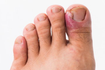 Nail Surgery